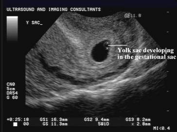 gestational sac size at 8 weeks